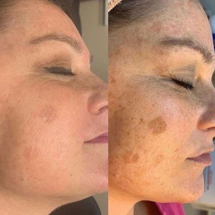 Royal Face Salto SP - O microagulhamento facial é um procedimento estético que é capaz de remover cicatrizes relacionadas às acnes, reduzir manchas na pele, atenuar rugas, linhas de expressão, promovendo o rejuvenescimento da face. Microagulhamento Royal Face Salto