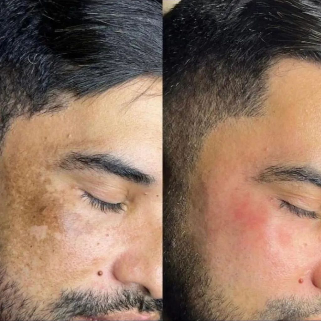 Microagulhamento Royal Face Salto