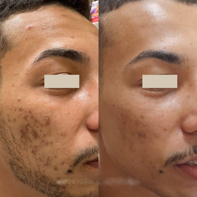 Microagulhamento Royal Face Salto