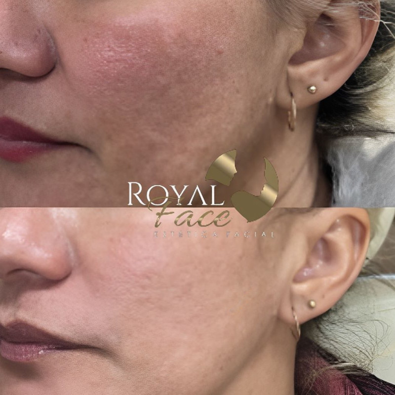 Microagulhamento Royal Face Salto